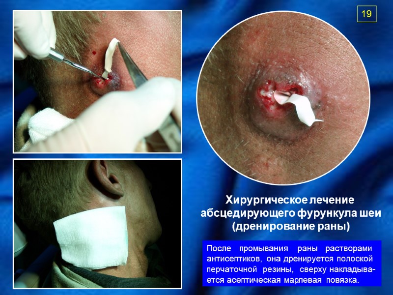 Хирургическое лечение  абсцедирующего фурункула шеи (дренирование раны) После   промывания  